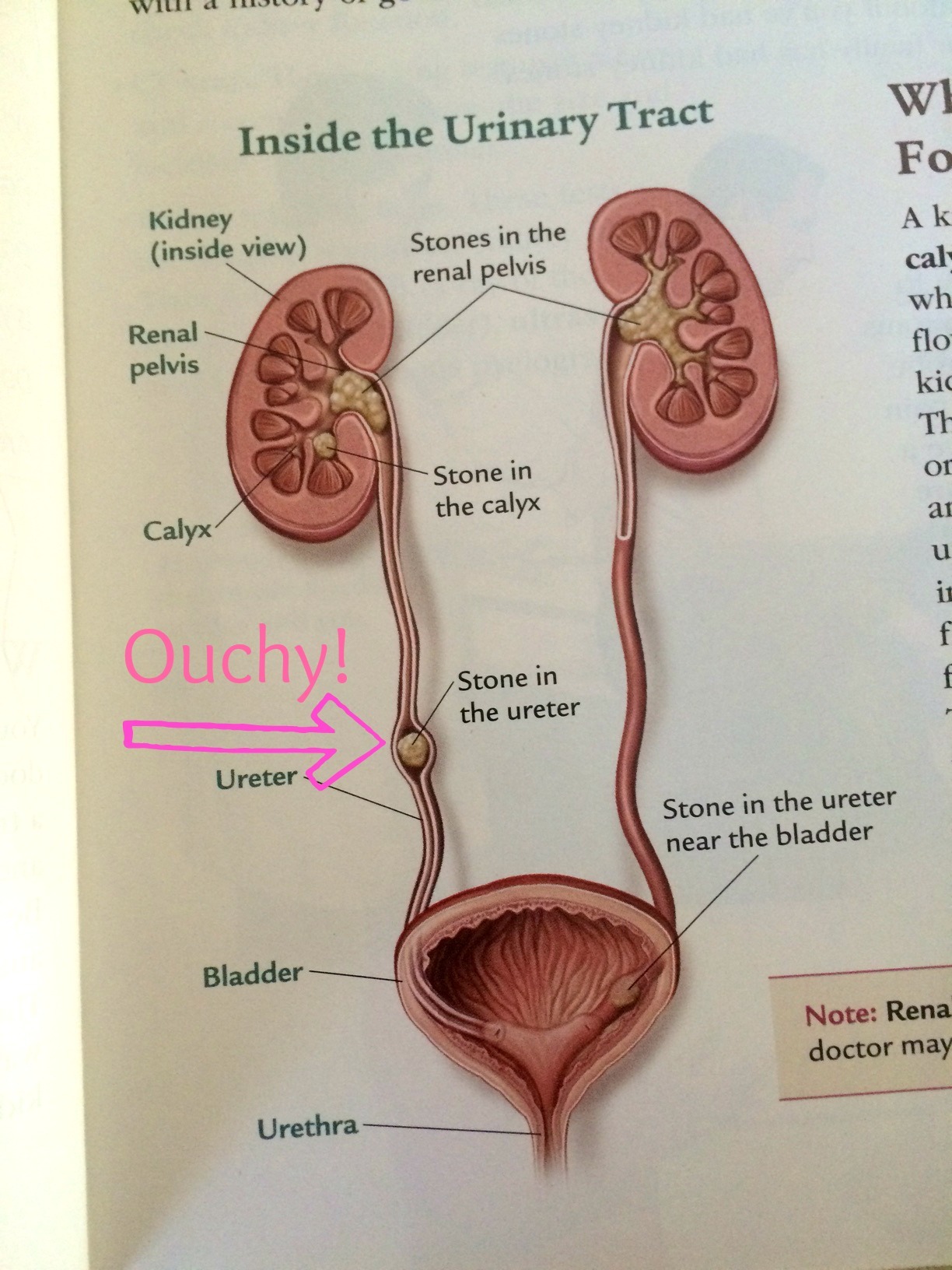 Raw Leafy Greens, Friend or Foe? Kidney Stones: A Lesson in Moderation